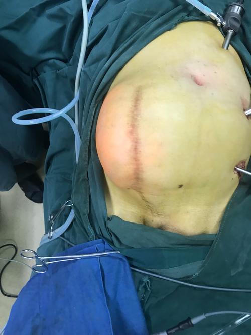 巨大腹壁切口疝