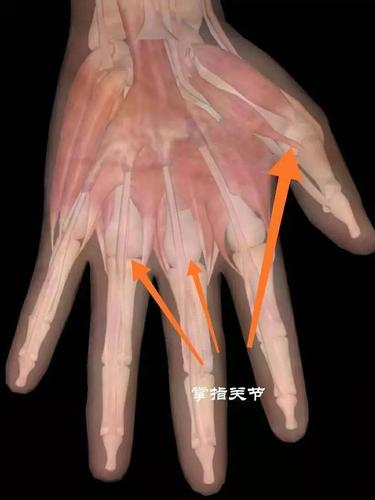 手指屈伸活动时伴弹响发生,掌指关节掌侧可触及硬韧结节,局部压痛