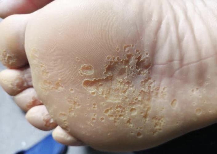 脚底下长水泡不一定都是脚气或者湿疹还有