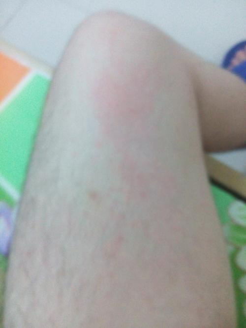 首页 传染科 艾滋病 已回复 性别:男年龄:21岁 病情描述: 请问这是