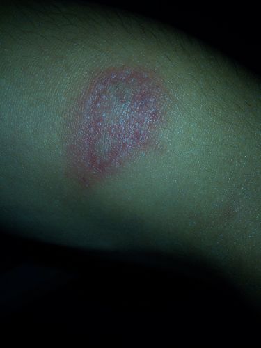 皮肤红一块中间是白色的白色中间又黑还有点点的白色凸起