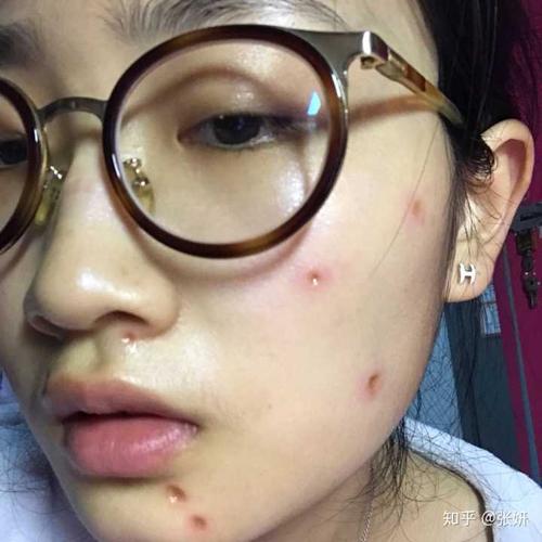 点痣后恢复过程特别痛苦,分享我的点痣经历.