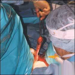 实拍:男变女变性手术全过程