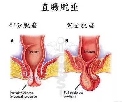 脱肛痔疮你还在羞羞地分不清楚