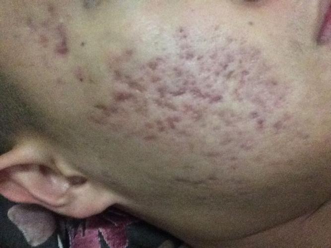 我脸这样是什么情况?痘印?痘疤?