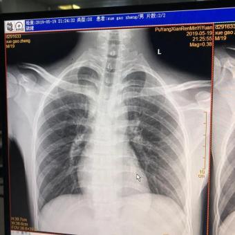 左锁骨中段骨折