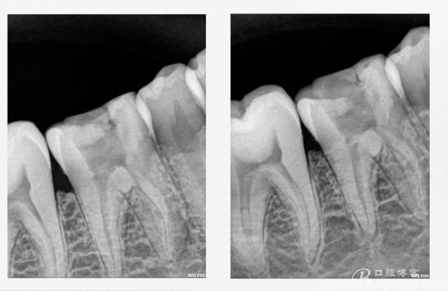 术前x线检查(全景片及局部小片,了解患牙基本情况)患者 男 30岁,右下