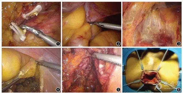 腹腔镜直肠癌根治经肛门切除标本套入式吻合术的临床疗效——李世拥