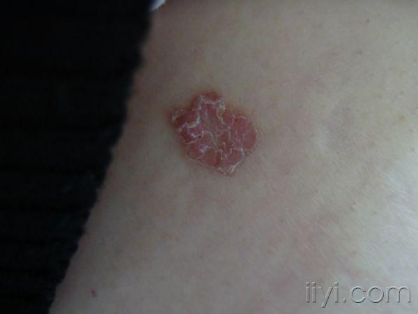 看图说话——钱币状湿疹?