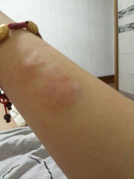 问:是不是荨麻疹?被虫子咬了!久而久之变成了这样,有时会痒,发红