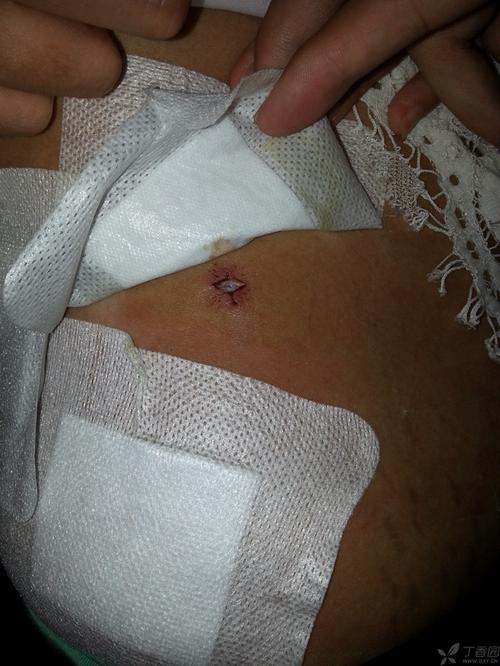 引流管所在切口拔除引流管后愈合不良?