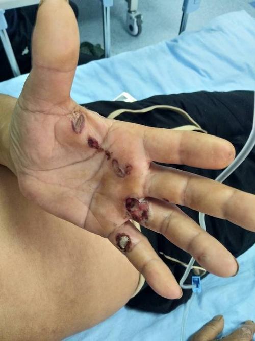 岐黄针治疗电击伤病例分享