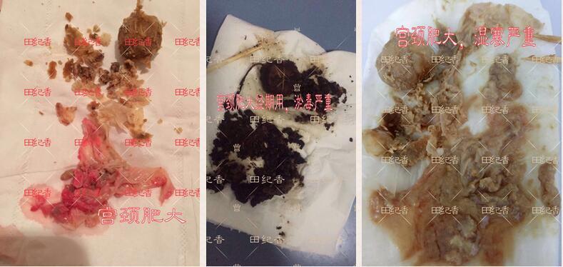 2,随着宫颈肥大拖延后加重,可引起子宫内膜炎,卵巢炎,输卵管黏连