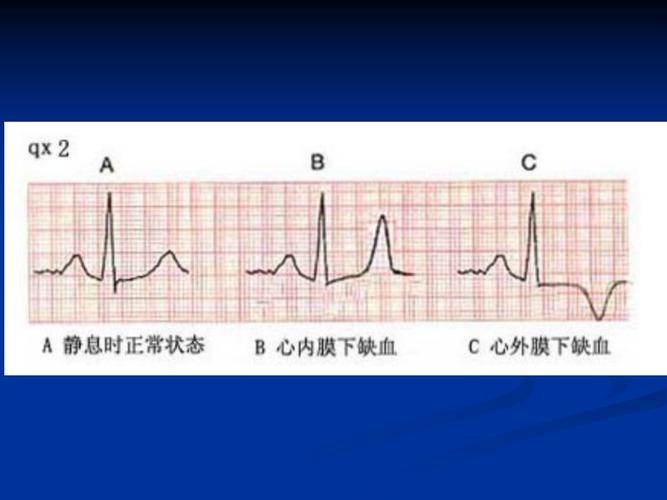 《心肌缺血心电图》