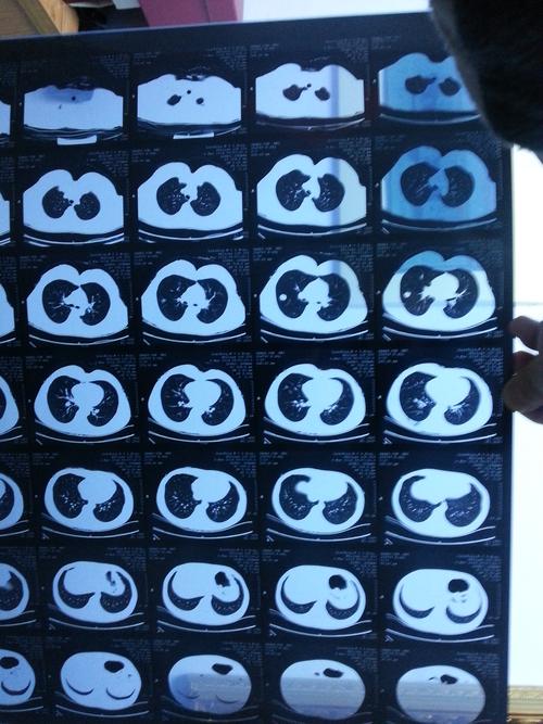 跪求 阅片,看看这是肺部肿瘤吗?