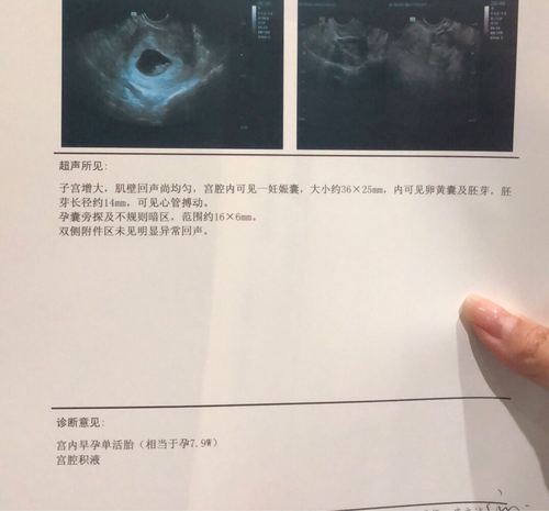 [试管婴儿]有谁家宝妈,怀孕发现有宫腔积液
