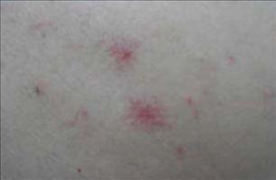 肝掌及蜘蛛痣图片