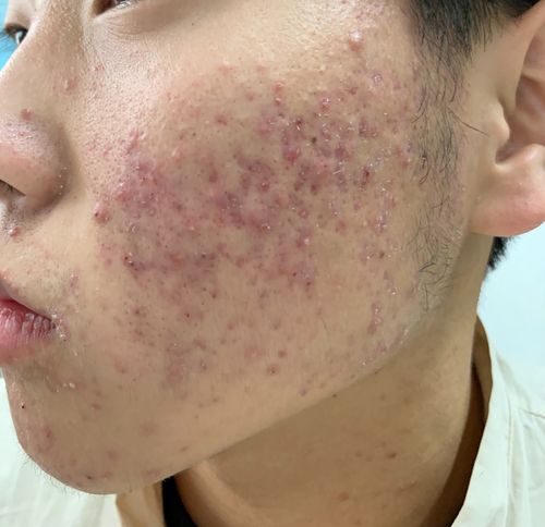 青少年痤疮(痘痘)能治吗?
