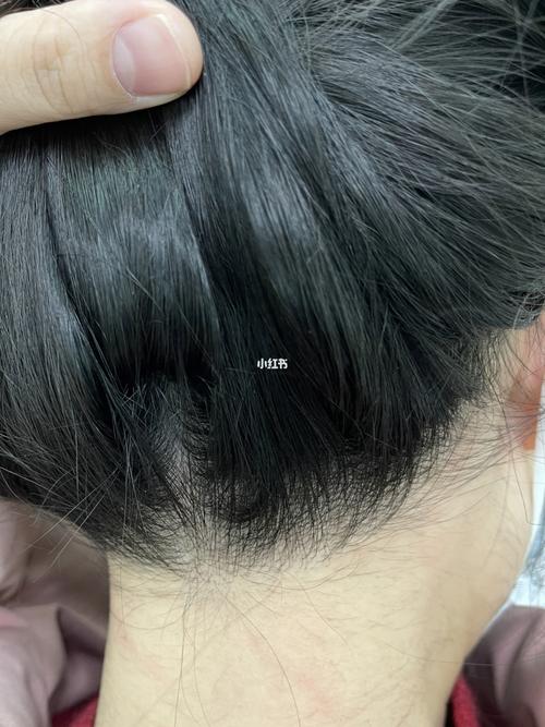 激光脱毛-后发际线_激光脱毛_脱毛_激光美容_美妆_个人护理_身体护理