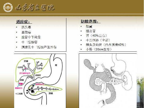 胰十二指肠切除术手术须知