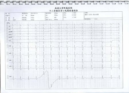 1,体检报告,心电图临界的(正常)心电图,详见附件图片