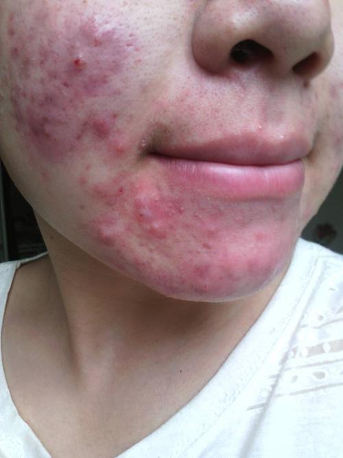 痘痘里边有白色的脓和类似于虫卵形状的固体东西,有的痘痘很大块很硬