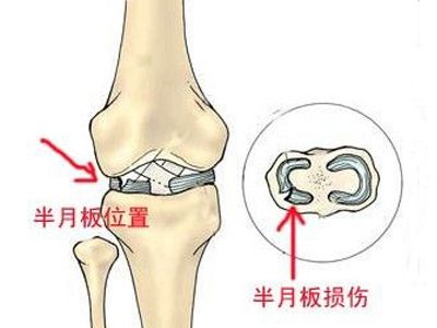半月板损伤能不能治愈