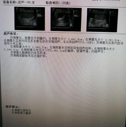 男性,45岁,居民 【主诉】 男性,45岁,居民 发现右侧附睾囊肿1月 【现