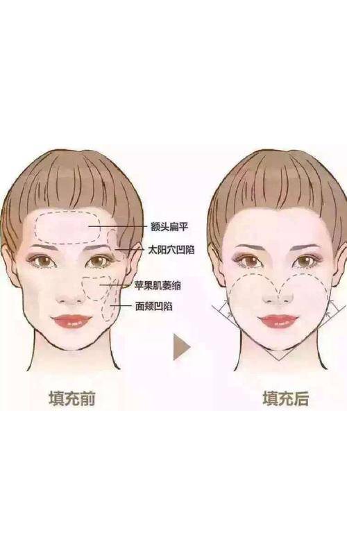 面部凹陷不是显瘦是显老
