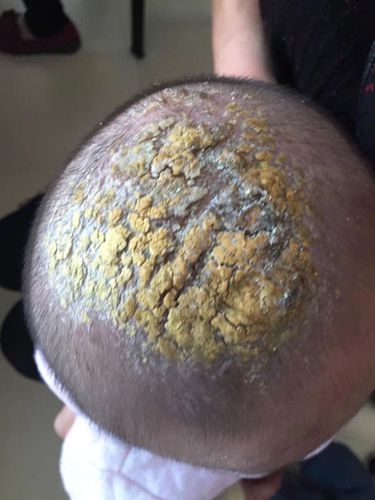 孩子头上这是啥啊!闹心闹心