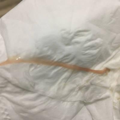 15周 之前8周见红 12周说孕囊有积液 昨晚性生活后 今天发现白带带血