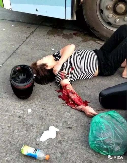 坡头爱周中学旁发生一起惨烈事故!一女士手臂骨头露出!