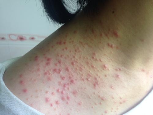 漫延时就有点痒,其它都不会痒,看了很多医生有的说皮囊炎,有的说湿疹