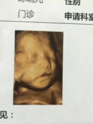 请各位宝妈帮我看一下这个四维是兔唇吗?四维哪里可以