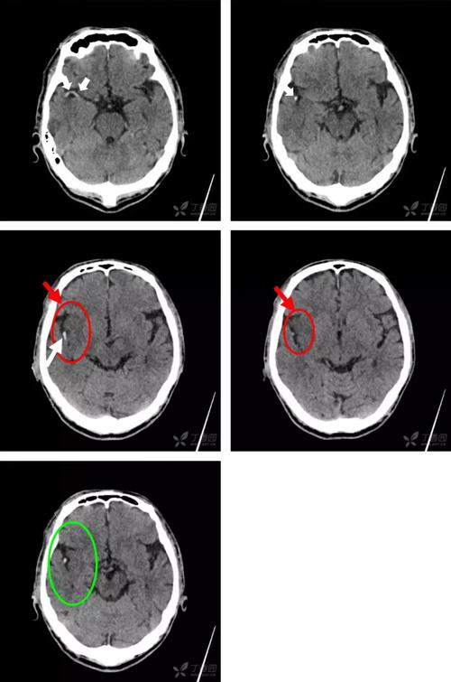 6 个病例学会「脑梗死」的 4 大 ct 征象