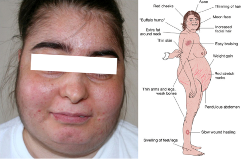 库欣综合征面容与库欣综合征的临床表现(图片来自网络)