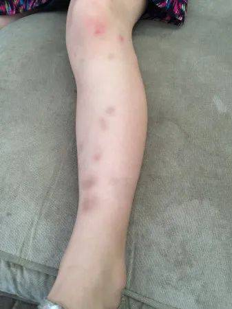 澳洲妈妈突然发现孩子身上不明淤青从此生活天翻地覆