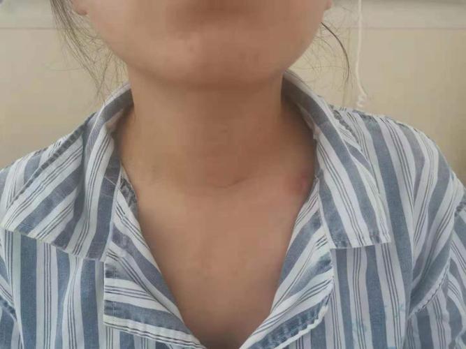 我院甲乳外科任东伟主任团队完成我院首例全乳晕入路腔镜下单侧甲状腺