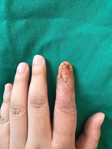 甲床感染坏死,自体甲移植