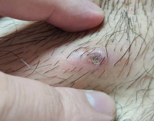 25 火疖子自行溃破自己在家消毒排脓了现在第二天了伤口这样正常么.