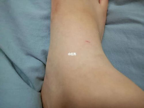 被狗咬了个特别小的伤口要怎么处理啊09_狗狗_被狗狗咬_医疗健康