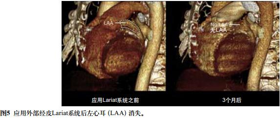 房颤采用机械方式闭合左心耳:现在是否应积极些?