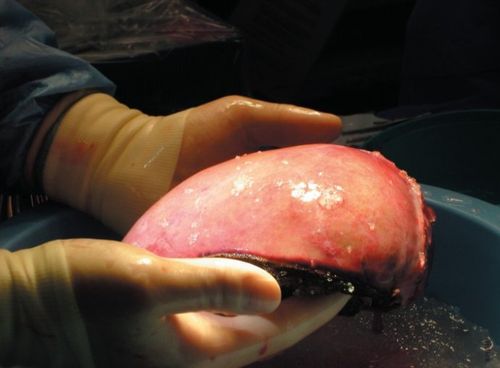 "器官移植旅行团"的血腥交易