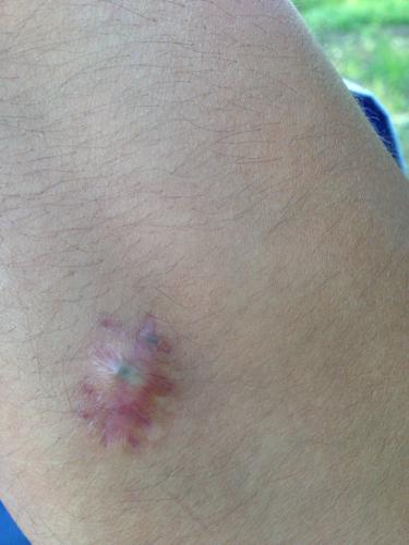 我左上肢有个纤维瘤,上次病理报告写的是(皮下慢性炎伴纤维胶原增生)