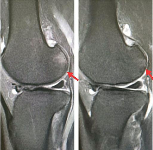 磁共振成像优势---膝关节