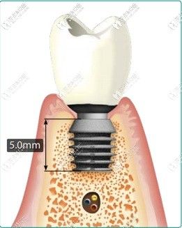 说百康种植体价格贵的对bicon种植体优点一定不了解
