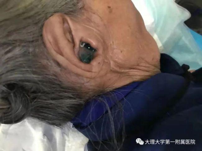 老人及小孩,早期症状经常不能及时发现,多在孵化成蛆后,蛆虫在外耳道