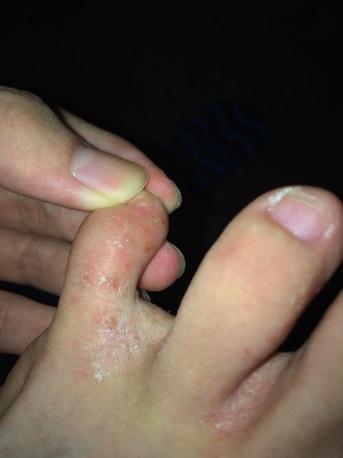 不好意思让你们恶心了 我脚上长了这个 很痒 怎么办