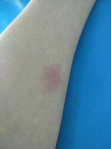 ppd皮试后这个样子怎么办