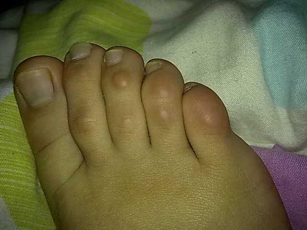 脚趾头上长有硬硬的包,那是什么? 60 2011-09-15 您好!